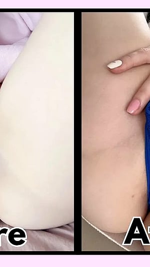 5 Years Of Feeling Myself After Labiaplasty